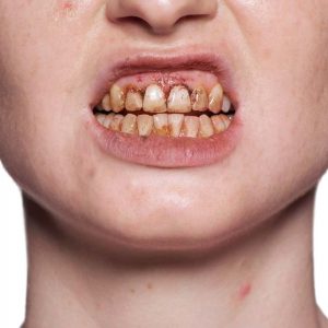 Tannlakk | Tooth Enamel